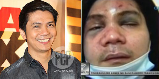 vhong navarro before and after the brutal attack