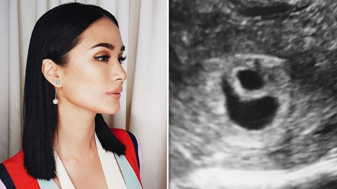 I didn't realize how much I wanted it': Heart Evangelista opens up on  motherhood, losing her twins