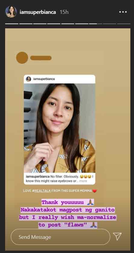 Bianca Gonzalez opens up about her acne breakouts