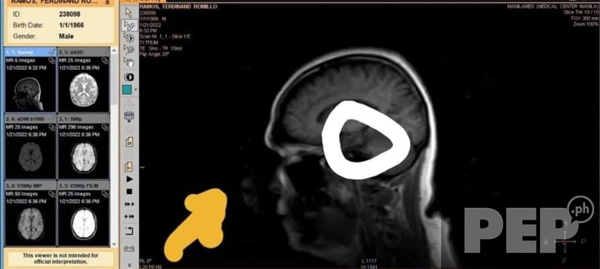 Raffy Romillo brain scan