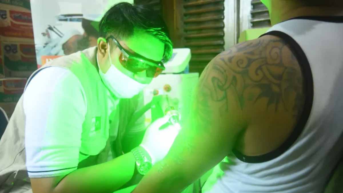 A professional doing a tattoo removal procedure